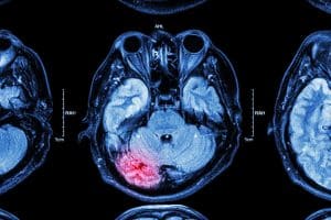 The Long-Term Consequences of Traumatic Brain Injury