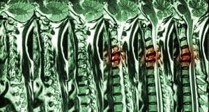 Understanding Spinal Cord Compression from Car Accidents