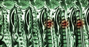Spinal Injury From Car Accident