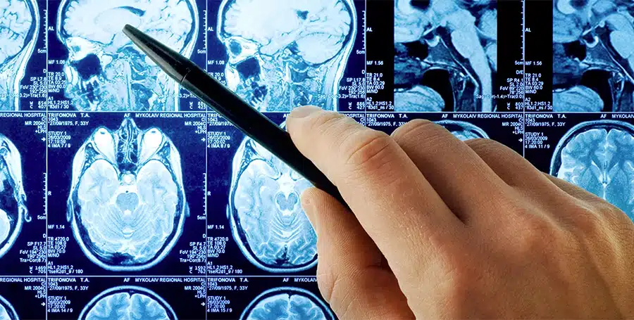 Boston Traumatic Brain Injury Lawyers